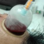 Urut tradisional | Sport Massage & Bekam | Cupping by Akmal