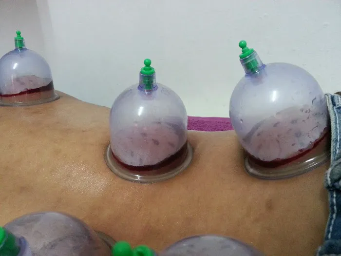 Urut dan Bekam Sunnah Suami Isteri Picture 1