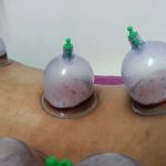 Urut dan Bekam Sunnah Suami Isteri