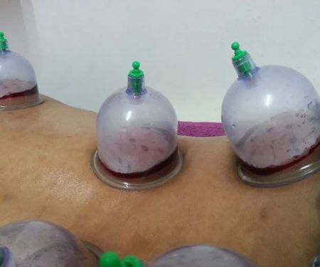 Urut dan Bekam Sunnah Suami Isteri